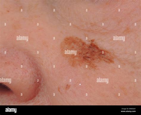 Lentigo Melanoma Man With A Lentigo Maligna Melanoma Series Stock