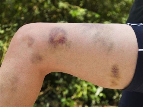 Bruises and blood clots both involve the blood vessels, but they differ greatly in potential seriousness. Why You Keep Finding Unexplained Bruises On Your Body ...