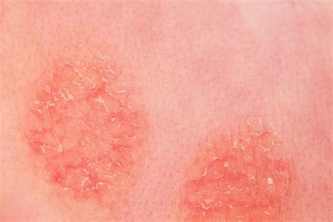 Discoid Eczema Symptoms Causes Diagnosis Treatment And Coping