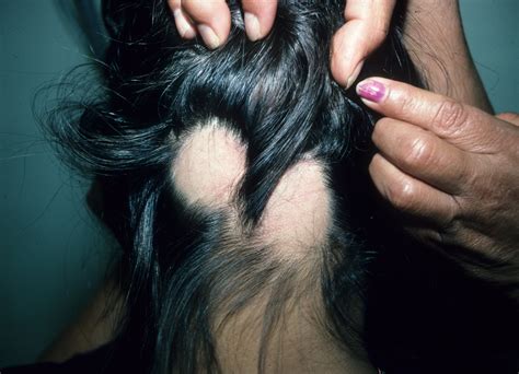 Top 124 Bald Spots In Womens Hair Polarrunningexpeditions