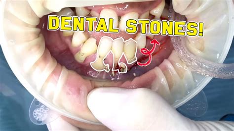 Satisfying Dental Cleaning Dental Scaling Youtube