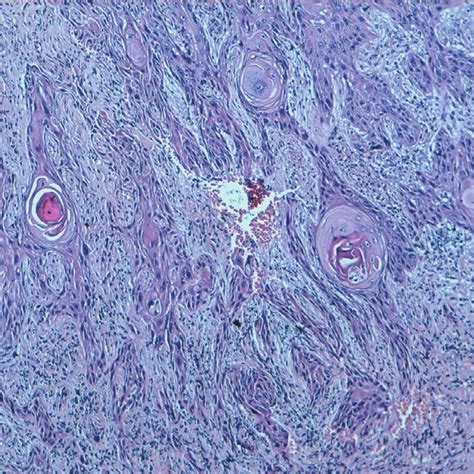 Well Differentiated Squamous Cell Carcinoma Keratinising Type With