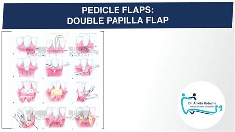 DOUBLE PAPILLA FLAP ROTATIONAL PEDICLE FLAPS ROOT COVERAGE TECHNIQUE DR