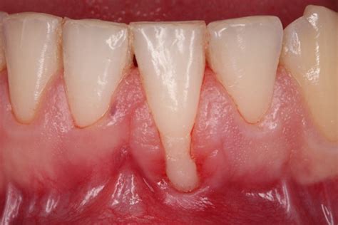 What Are The Causes And Treatments Of Gingival Recession PANDA ORAL