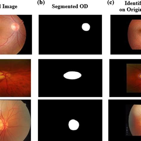 Two Stage Framework For Optic Disc Segmentation And Estimation Of Cup