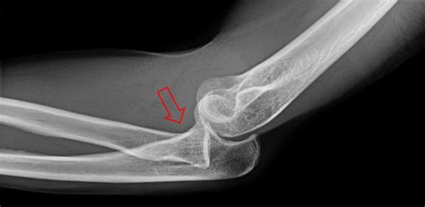 Cureus Radial Head Dislocation With Elbow Subluxation In An Adult