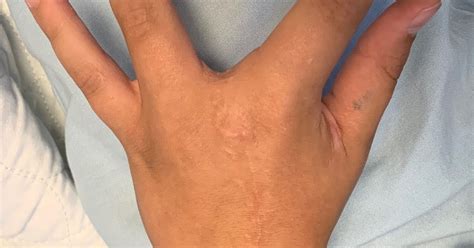 Cleft Hand Beyond The Basics Congenital Hand And Arm Differences