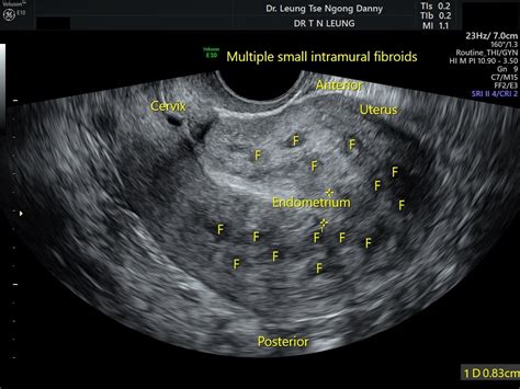 Uterine Fibroid Leiomyoma Hkog Info