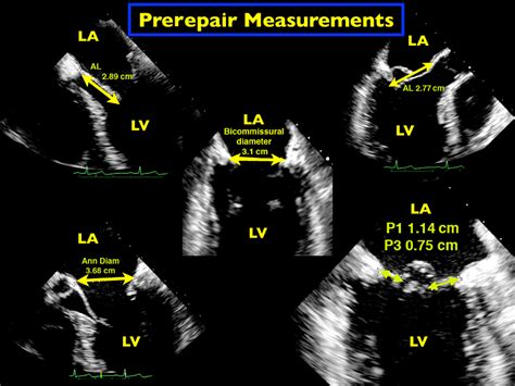 Mitral Valve Repair An Echocardiographic Review Part 1 Journal Of