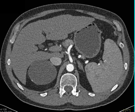 Right Adrenal Cyst With Faint Calcification In The Cyst Wall Adrenal