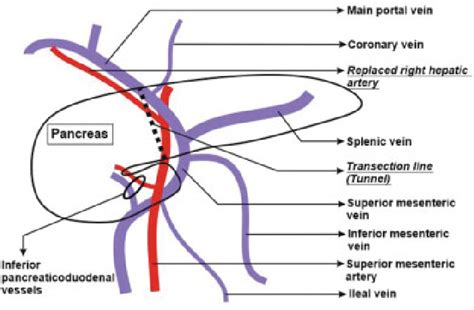 Schematic Diagram Showing The Vascular Anatomy In Our Patient With
