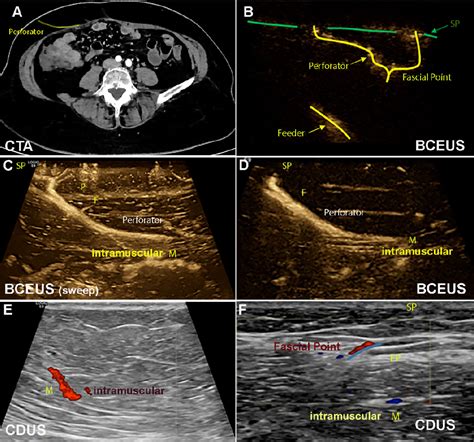 Figure 2 From Preoperative Perforator Mapping In Diep Flaps For Breast