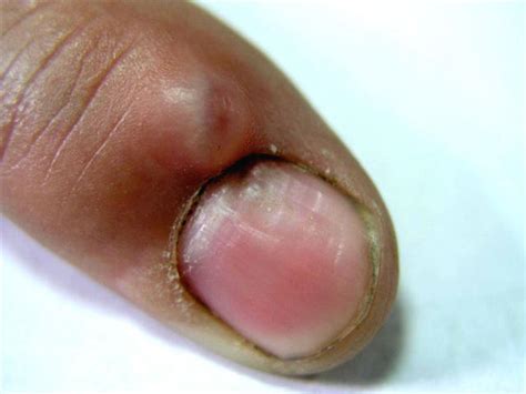Nail Diseases Mucous Cyst Picture Hellenic Dermatological Atlas
