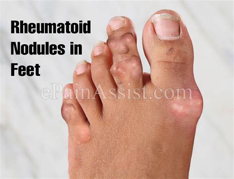 What Are Rheumatoid Nodules Know Its Causes Treatment And Is It A Cause