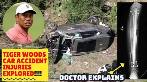 Tiger Woods Car Crash Update Doctor Explains His Injuries The Broken