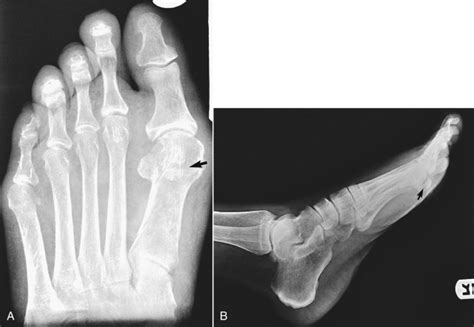 Toe Fractures Anesthesia Key