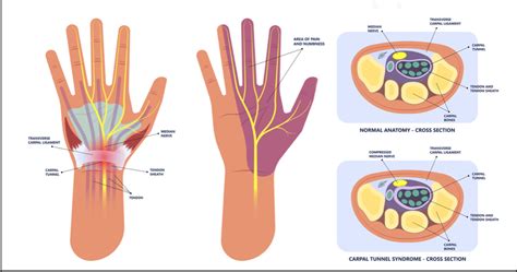Pronator Teres Syndrome Vs Carpal Tunnel Syndrome Pain Free Health