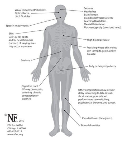 Neurofibromatosis Type I Physiopedia