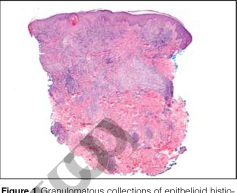 Figure 1 From Indurated Erythematous Papules And Plaques On The Forearm
