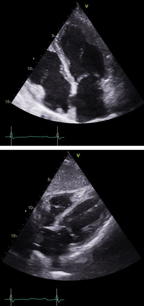 Myocarditis is rare, but is not a new disease treatment largely supportive myocarditis after mrna vaccines: Idiopathic eosinophilic myocarditis presenting with features of an acute coronary syndrome in ...