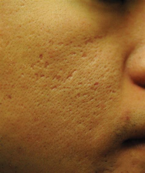 Acne Scar Treatment Before After Photos Seattle Bellevue