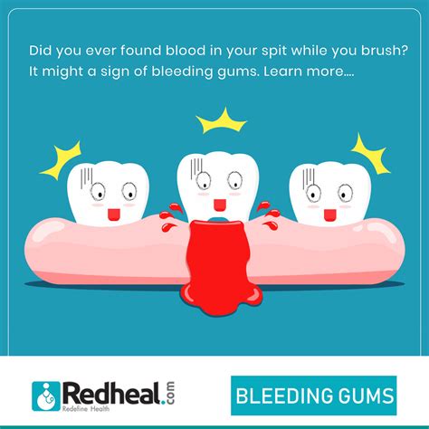 Bleeding Gums Bleeding Gums Are Considered To Be The Most Flickr