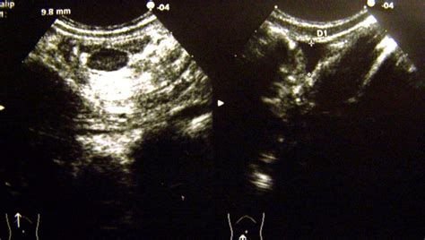 L’importanza dell’ecografia addominale nella diagnosi di invaginazione