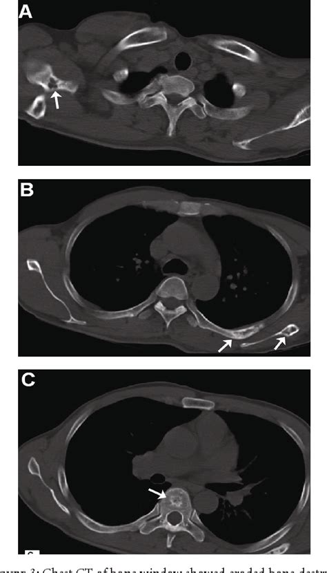 Figure 3 From Multiple Metastasis Like Bone Lesions In Scintigraphic