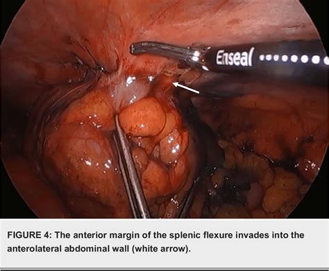 Figure 4 From Medial To Lateral Approach To The Splenic Flexure Resection And End Transverse