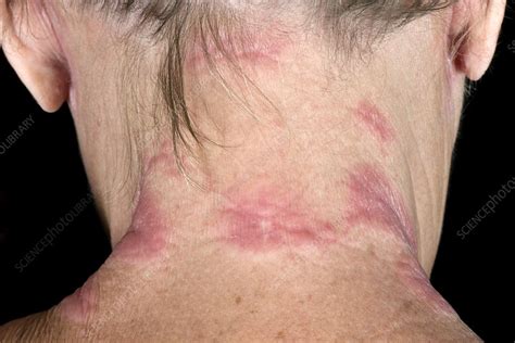 Eczema On The Neck Stock Image C0461000 Science Photo Library