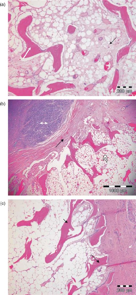 A Case 3 Osteoma Histopathology Hande Showing Central Cancellous Bone