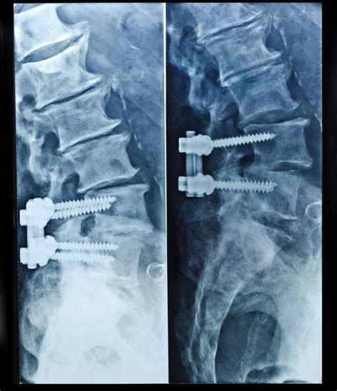 Anterior Lumbar Interbody Fusion Alif