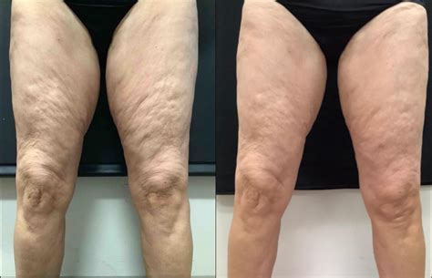 Exilis Ultra Skin Tightening Before And After Photos Patient 35 Washington Dc Mi Skin