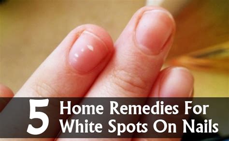 5 Amazing Home Remedies For White Spots On Nails Search Herbal And Home