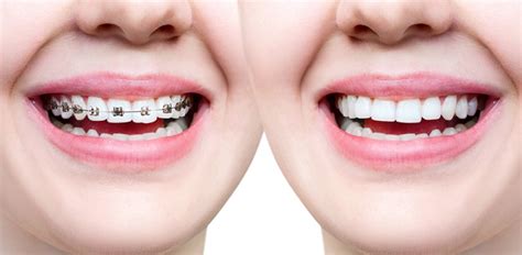 Orthodontic Treatment Results Braces Before And After Images