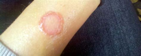 The 11 Best At Home Remedies For Ringworm Naturalalternativeremedy