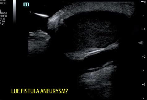 Arteriovenous Graft Pseudoaneurysm Jetem