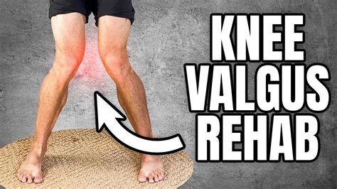 Knock Knees Correction Knee Valgus Exercises Youtube