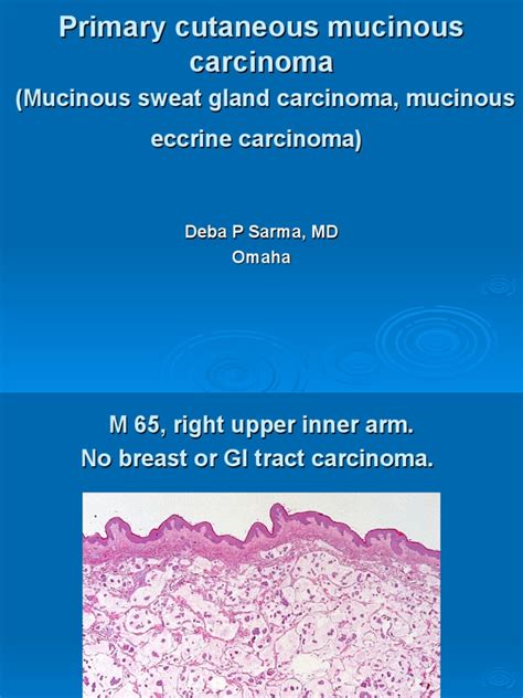 Mucinous Sweat Gland Carcinoma Mucinous Eccrine Carcinoma Pdf