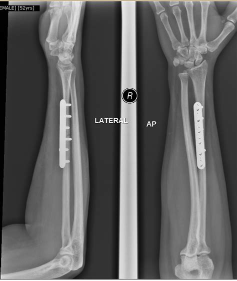 Forearm Single Bone Fracture The Orthopedics Malaysia Blog