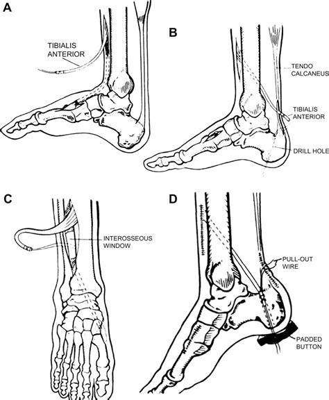 Tibialis Anterior Tendon Shortening In Combination With Achilles Tendon Lengthening In Spastic