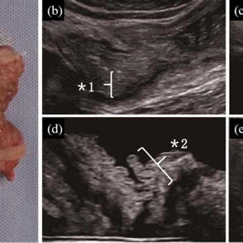 Cobblestone Like Appearance In Hepatic Flexure Of The Ascending Colon Download Scientific