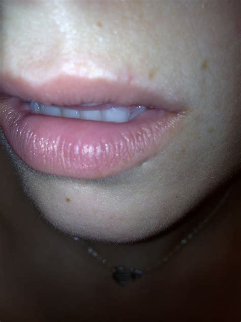 White Swollen Spot On Lip Three Weeks No Changes