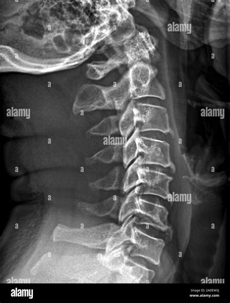 Spinal Arthritis X Ray Of A Section Through The Cervical Spine Neck