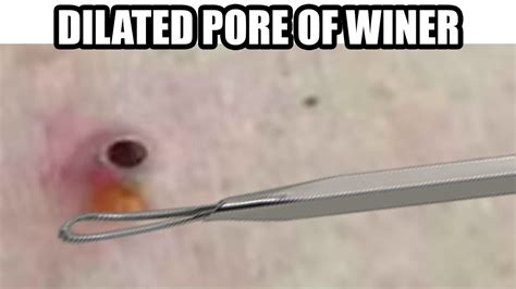 Dilated Pore Of Winer Dr John Gilmore Youtube