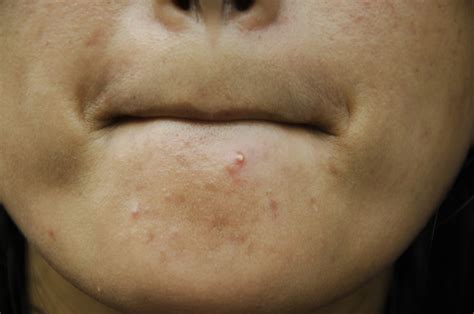 Cystic Acne On Chin How I Finally Cleared My Chin 9 Days