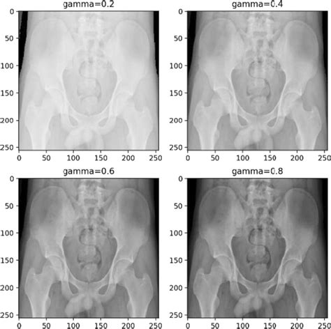Adjustments Of Contrast And Luminance Of Pelvis X Ray Image Download