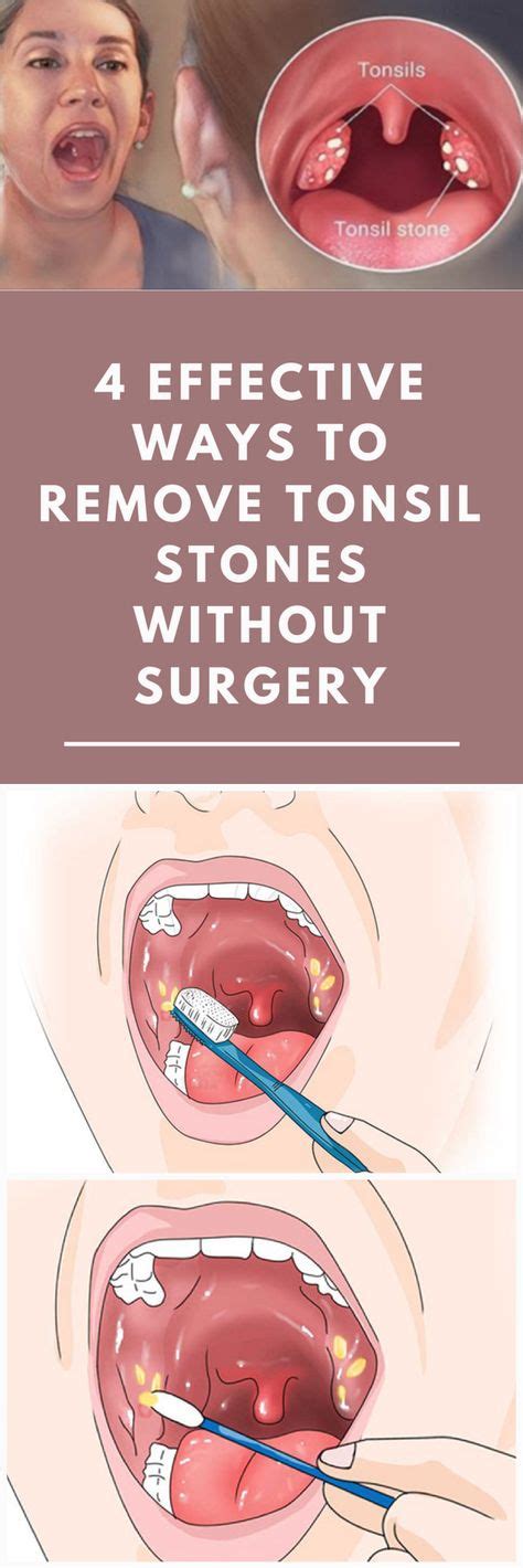 Pin On Tonsil Stones Treatment Guide