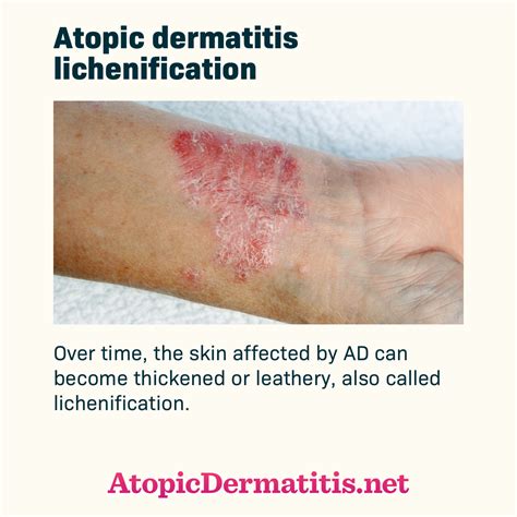 Atopic Dermatitis And Skin Symptoms Pictures Rash Skin Pictures