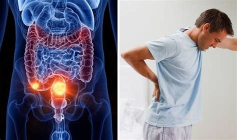 Bowel Cancer Symptoms Rare But Painful Sign In Your Back Could Signal